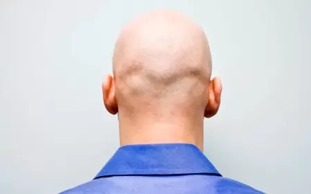 خبر سار لنحو نصف رجال العالم.. علاج لن تتوقعه للصلع الوراثي