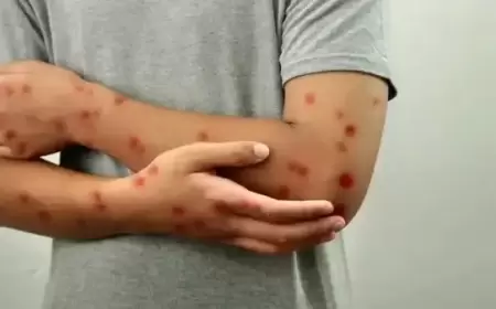 إفريقيا تسجل أكثر من 18700 حالة جدري قردة محتملة في 2024