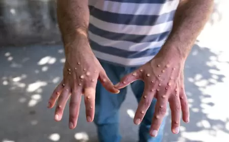 مصر.. وزارة الصحة تستنفر على مستوى المديريات للتصدي لـ"جدري القردة"