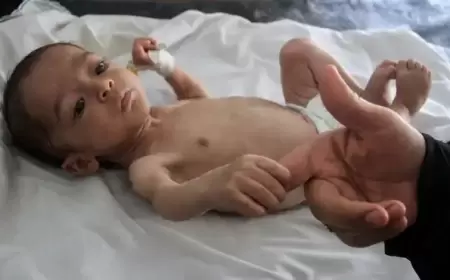 ارتفاع عدد شهداء سوء التغذية بغزة إلى 37 طفلاً