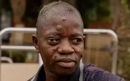 بكميات محدودة.. لقاحات جدري القرود تصل الكونغو للتصدي للوباء