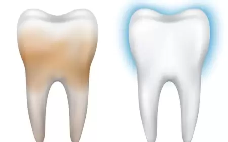 7 علاجات منزلية لإزالة البقع الصفراء من الأسنان