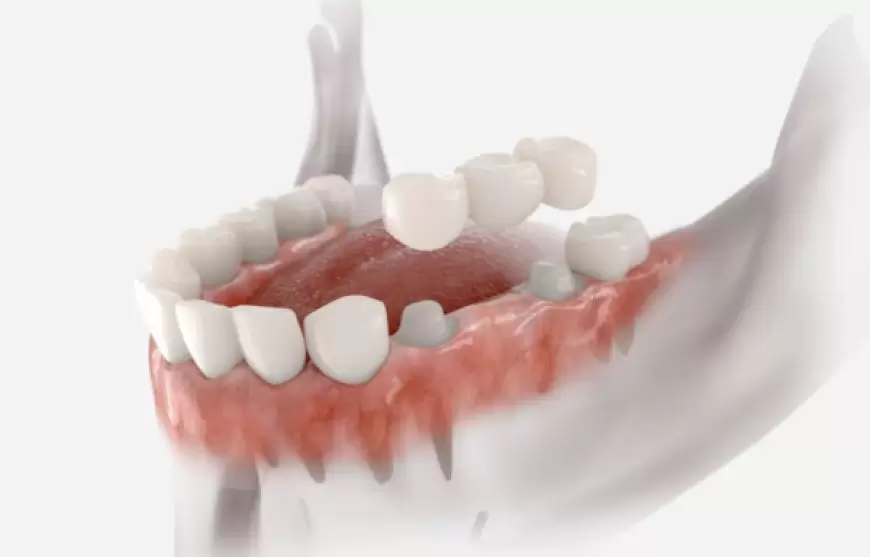 الذكاء الاصطناعي في طب الأسنان الترميمي