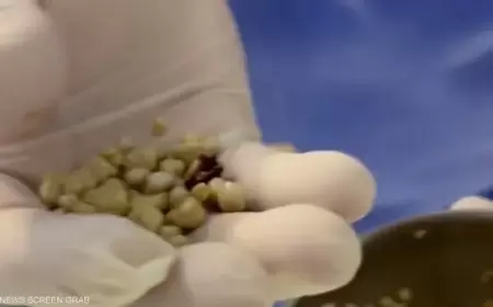 بسبب المشروبات الغازية.. طبيب يستخرج 30 حصوة من كلية رجل