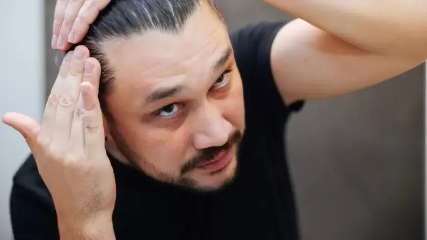 سكر طبيعي في الجسم قد يكون مفتاحاً لعلاج الصلع الوراثي