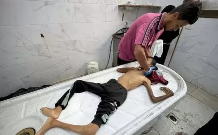 5 وفيات نتيجة المجاعة وسوء التغذية خلال الـ24 ساعة الماضية