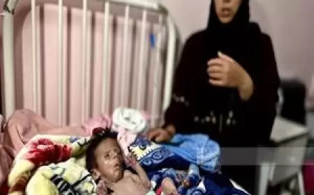 5 وفيات بينهم طفلان نتيجة المجاعة وسوء التغذية في قطاع غزة