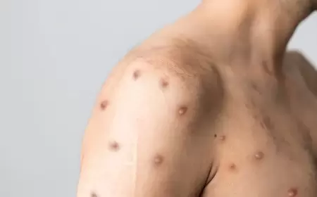 منظمة الصحة العالمية ترفع حالة الطوارئ بشأن جدري القردة