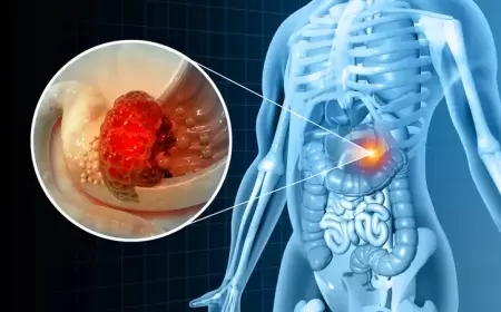سرطان منسي يتزايد بين الشباب.. والخبراء محتارون