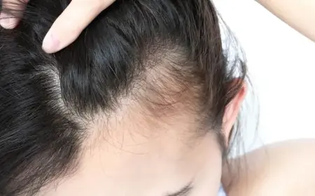 حل سحري للصلع الوراثي للرجال والنساء.. مستخلص من نبات ستيفيا