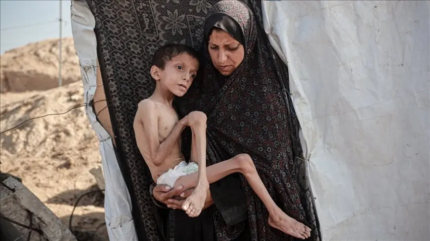 الأمم المتحدة: عدد حالات سوء التغذية الحاد بغزة ارتفع إلى 95 ألفا