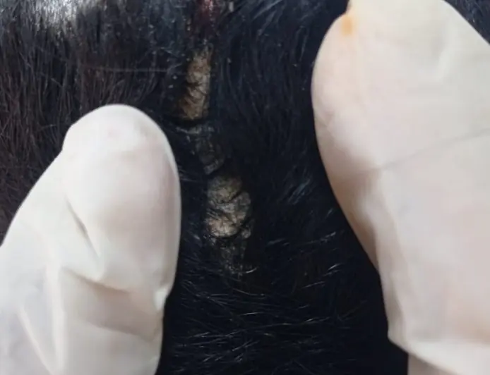 انتشار مرض الصدفية في قطاع غزة في ظل الحروب والأزمات الإنسانية تقرير تحليلي معمّق ببصمة بحثية