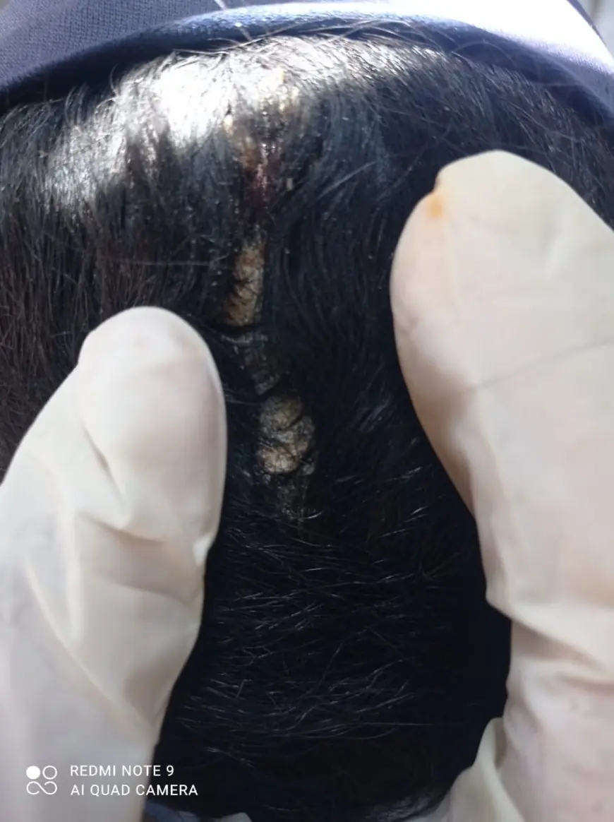 انتشار مرض الصدفية في قطاع غزة في ظل الحروب والأزمات الإنسانية تقرير تحليلي معمّق ببصمة بحثية