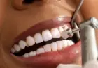 وداعاً للتسوس.. جل جديد يُعيد بناء مينا الأسنان